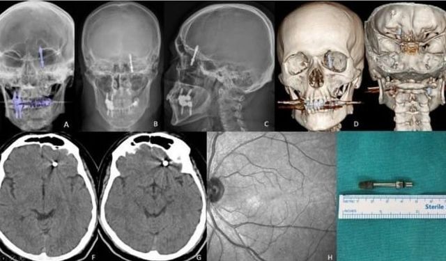 Bursa'da korkunç olay! İmplant sırasında vida beynine saplandı